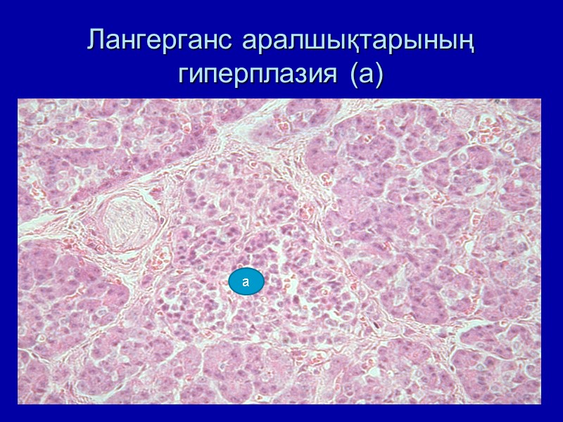 Лангерганс аралшықтарының  гиперплазия (а) а